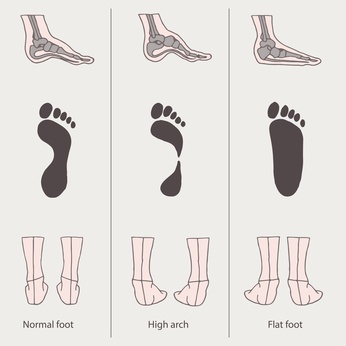 Tipus de peus segons la petjada plantar (per ordre: normal, cavo i pla).