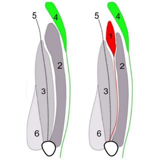 #1 - Tensor Vastus Intermedius